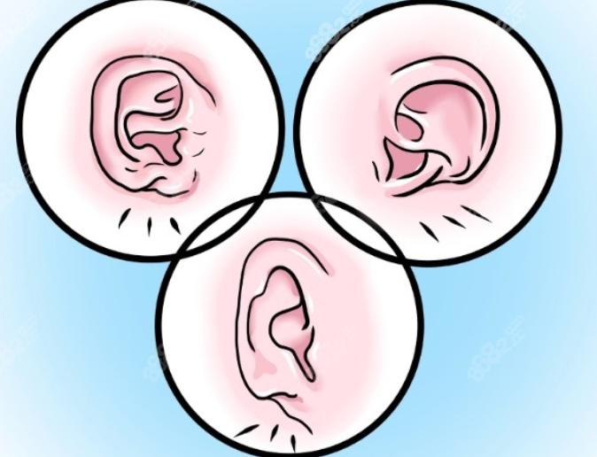 北京上海广州私立医院王冰清耳再造实例对比：三大维度看差异