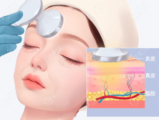 吴家强医生激光紧致提升做的好 吴家强医生激光紧致提升做的好