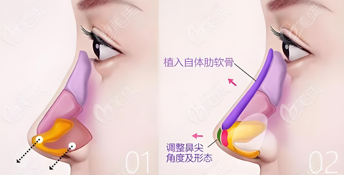 李信鋒做鼻子多少錢