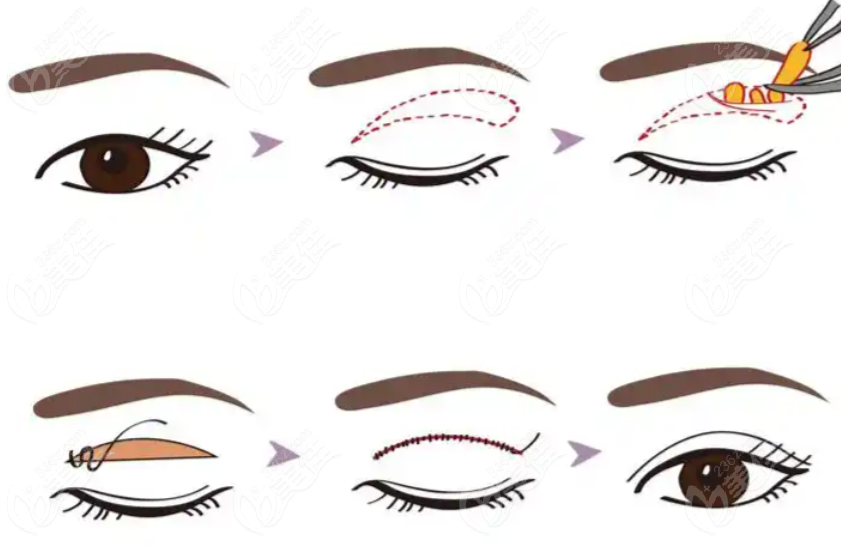 双眼皮成形