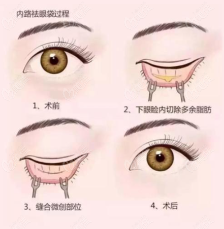 祛眼袋术