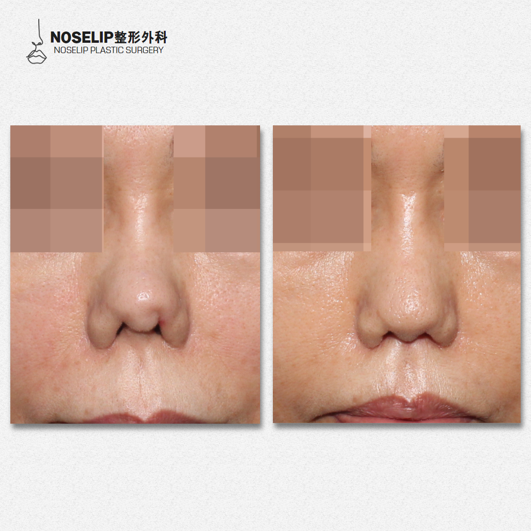 上海梁亮鼻修复技术怎么样